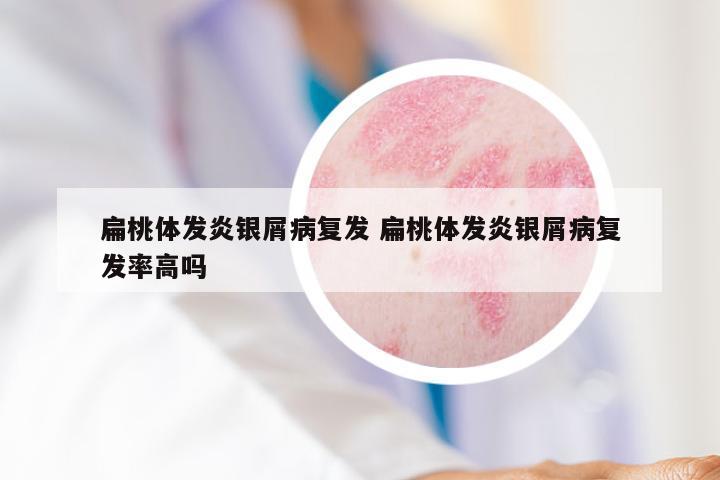 扁桃体发炎银屑病复发 扁桃体发炎银屑病复发率高吗