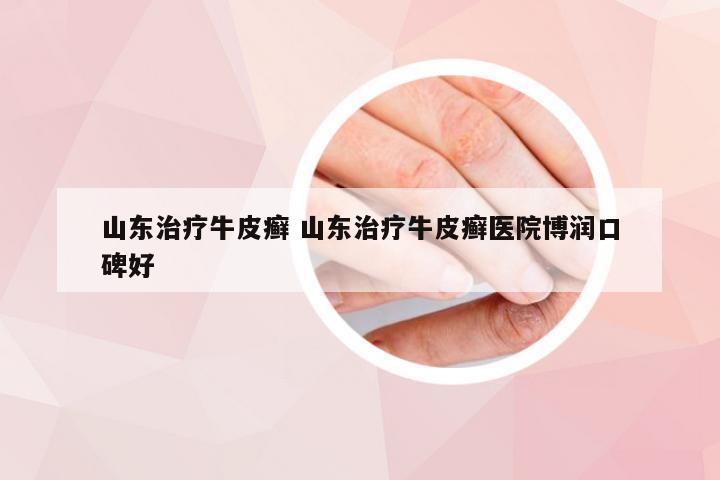 山东治疗牛皮癣 山东治疗牛皮癣医院博润口碑好