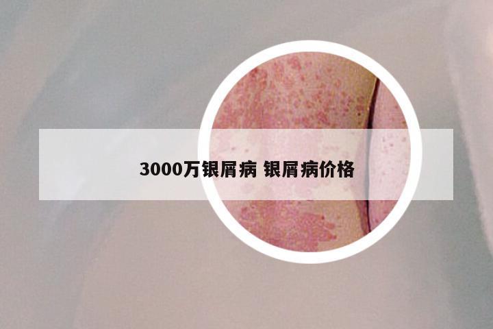 3000万银屑病 银屑病价格