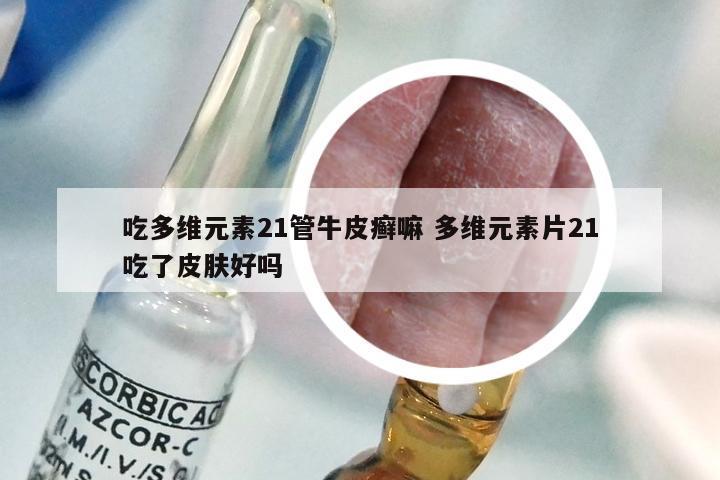 吃多维元素21管牛皮癣嘛 多维元素片21吃了皮肤好吗