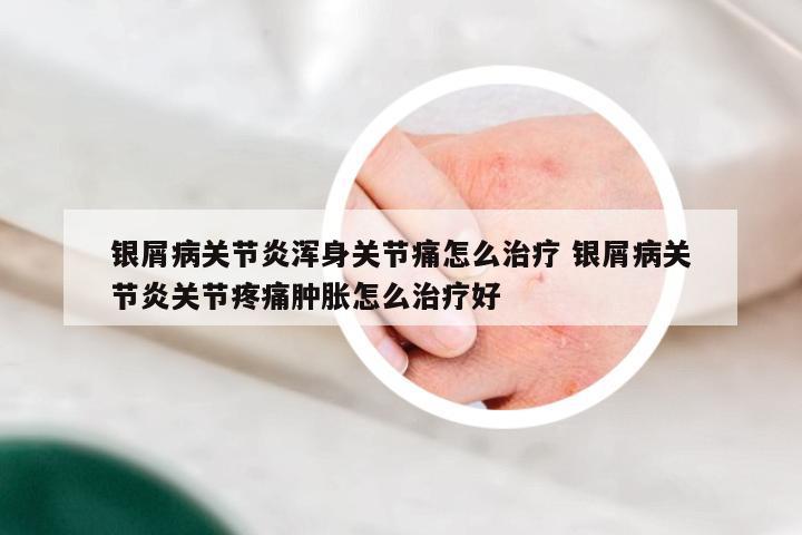 银屑病关节炎浑身关节痛怎么治疗 银屑病关节炎关节疼痛肿胀怎么治疗好