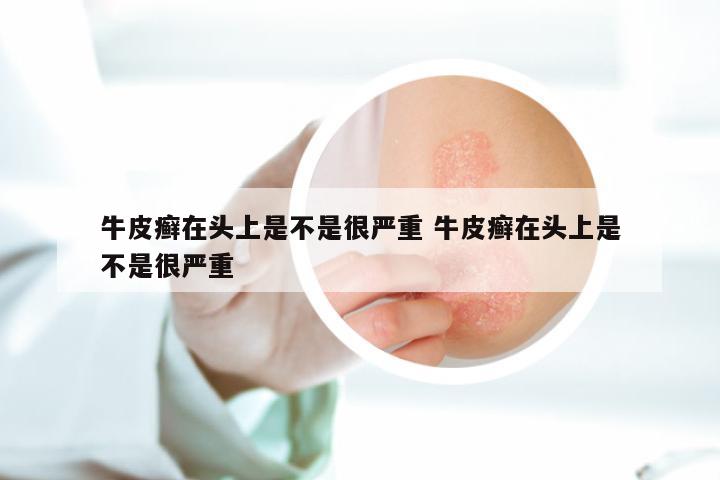 牛皮癣在头上是不是很严重 牛皮癣在头上是不是很严重