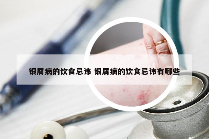 银屑病的饮食忌讳 银屑病的饮食忌讳有哪些