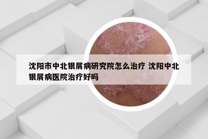 沈阳市中北银屑病研究院怎么治疗 沈阳中北银屑病医院治疗好吗