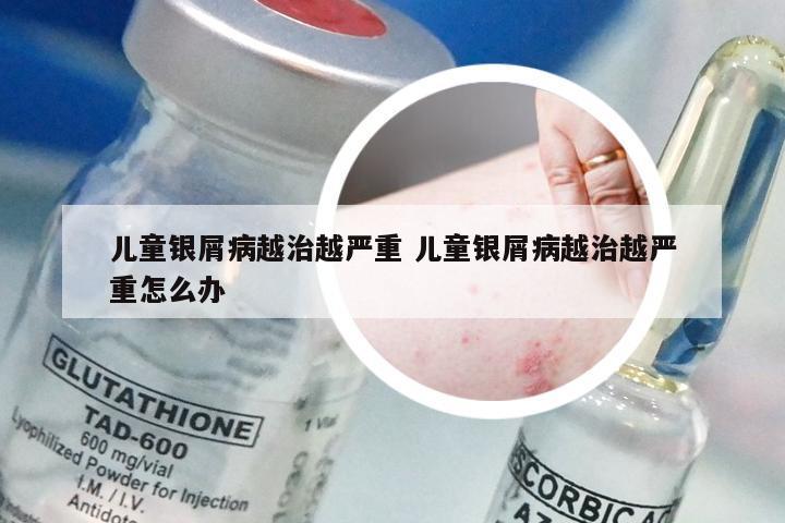 儿童银屑病越治越严重 儿童银屑病越治越严重怎么办