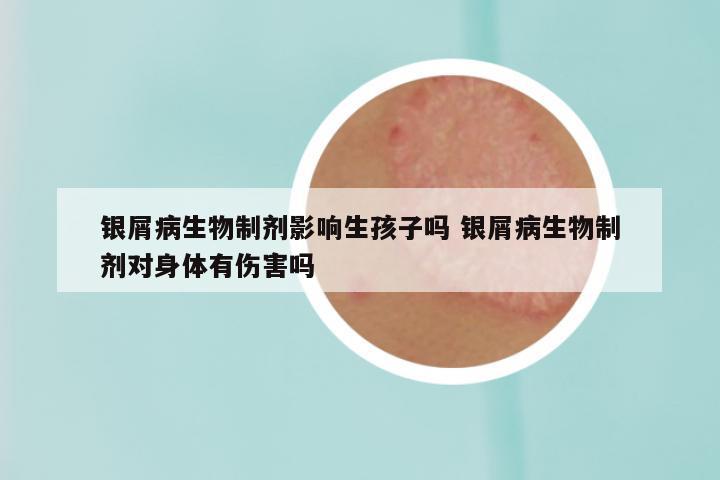 银屑病生物制剂影响生孩子吗 银屑病生物制剂对身体有伤害吗