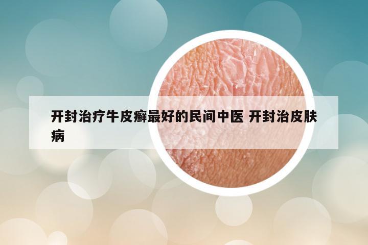 开封治疗牛皮癣最好的民间中医 开封治皮肤病