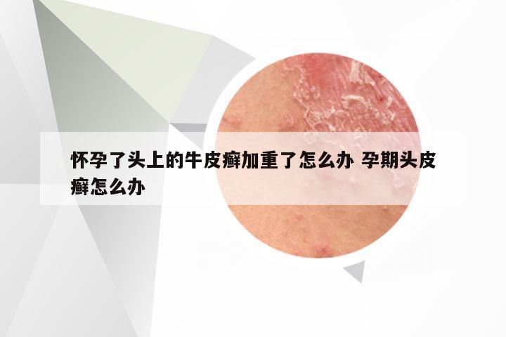 怀孕了头上的牛皮癣加重了怎么办 孕期头皮癣怎么办