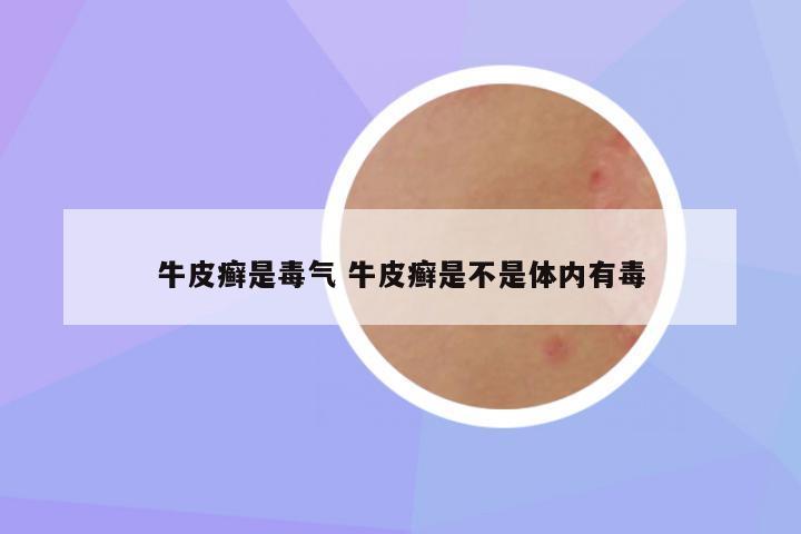 牛皮癣是毒气 牛皮癣是不是体内有毒