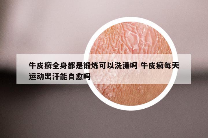 牛皮癣全身都是锻炼可以洗澡吗 牛皮癣每天运动出汗能自愈吗