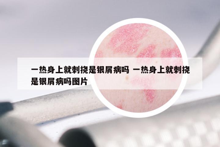一热身上就刺挠是银屑病吗 一热身上就刺挠是银屑病吗图片