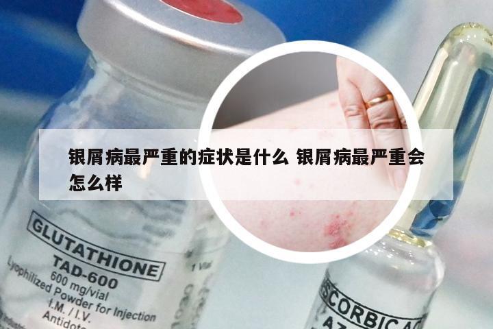 银屑病最严重的症状是什么 银屑病最严重会怎么样