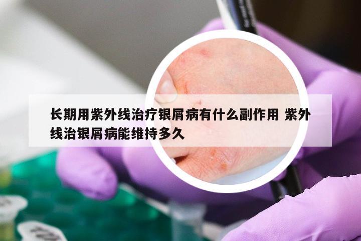 长期用紫外线治疗银屑病有什么副作用 紫外线治银屑病能维持多久