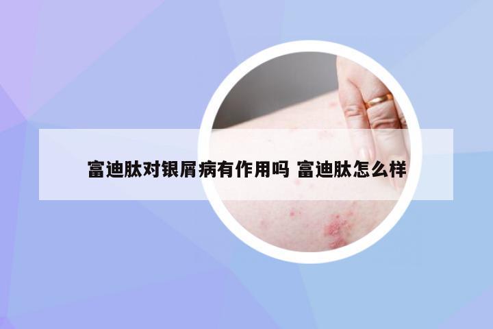 富迪肽对银屑病有作用吗 富迪肽怎么样