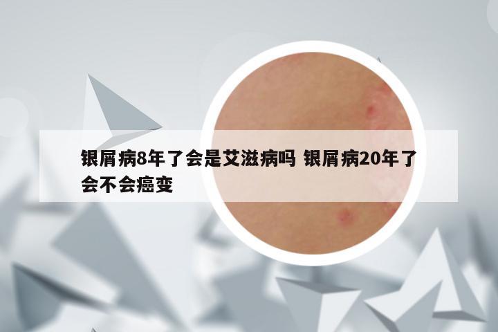 银屑病8年了会是艾滋病吗 银屑病20年了会不会癌变