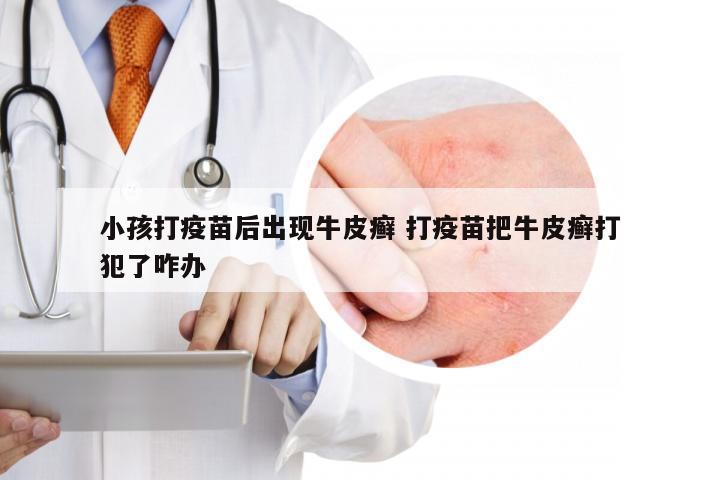 小孩打疫苗后出现牛皮癣 打疫苗把牛皮癣打犯了咋办