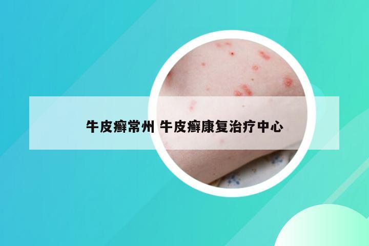 牛皮癣常州 牛皮癣康复治疗中心