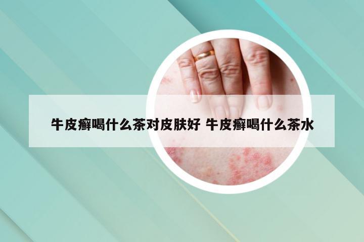 牛皮癣喝什么茶对皮肤好 牛皮癣喝什么茶水