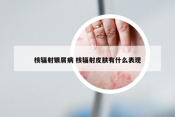 核辐射银屑病 核辐射皮肤有什么表现