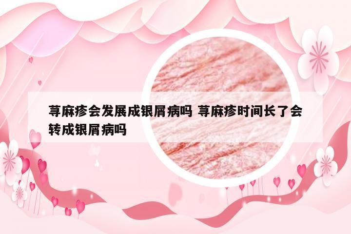 荨麻疹会发展成银屑病吗 荨麻疹时间长了会转成银屑病吗