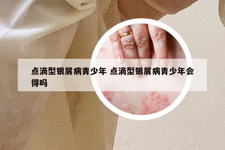 点滴型银屑病青少年 点滴型银屑病青少年会得吗