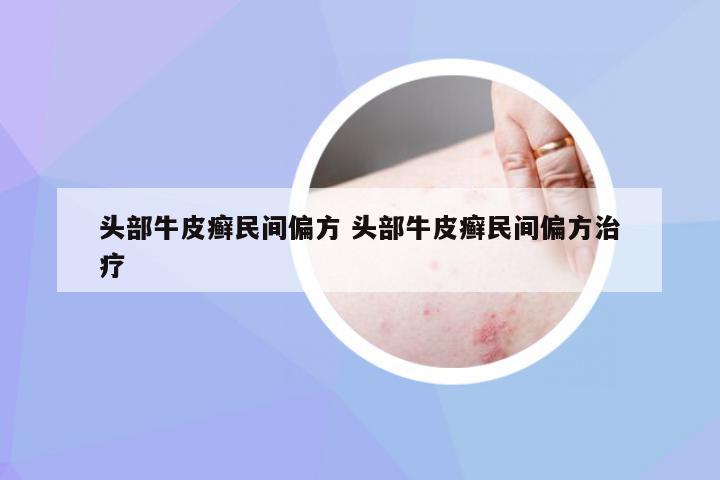 头部牛皮癣民间偏方 头部牛皮癣民间偏方治疗