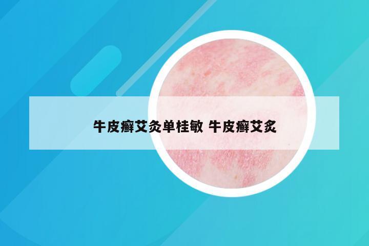 牛皮癣艾灸单桂敏 牛皮癣艾炙