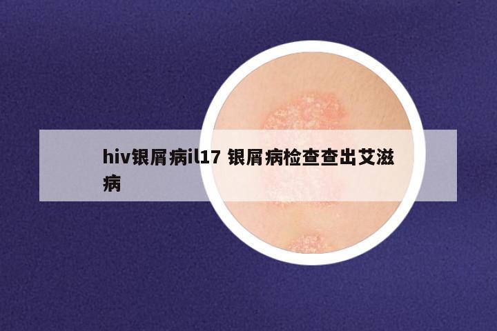 hiv银屑病il17 银屑病检查查出艾滋病