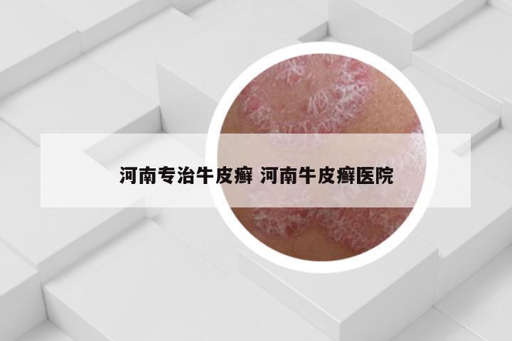 河南专治牛皮癣 河南牛皮癣医院