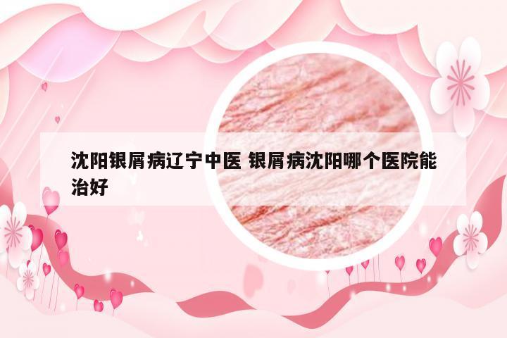 沈阳银屑病辽宁中医 银屑病沈阳哪个医院能治好