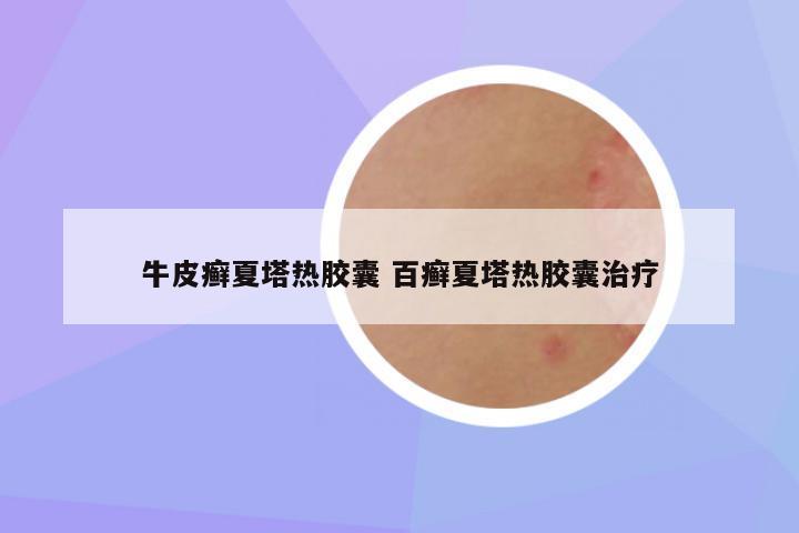 牛皮癣夏塔热胶囊 百癣夏塔热胶囊治疗