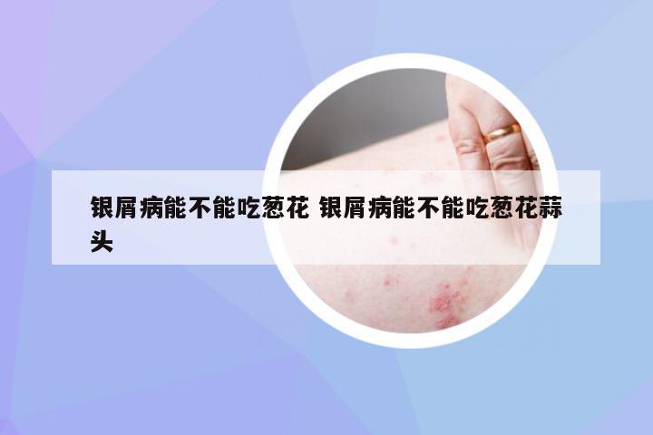 银屑病能不能吃葱花 银屑病能不能吃葱花蒜头