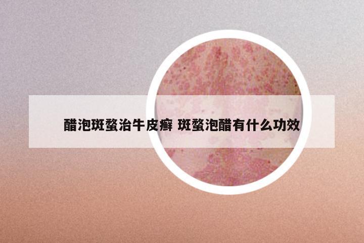 醋泡斑蝥治牛皮癣 斑蝥泡醋有什么功效