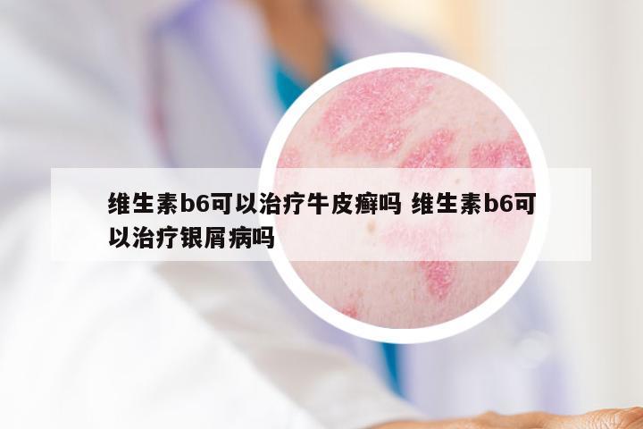 维生素b6可以治疗牛皮癣吗 维生素b6可以治疗银屑病吗