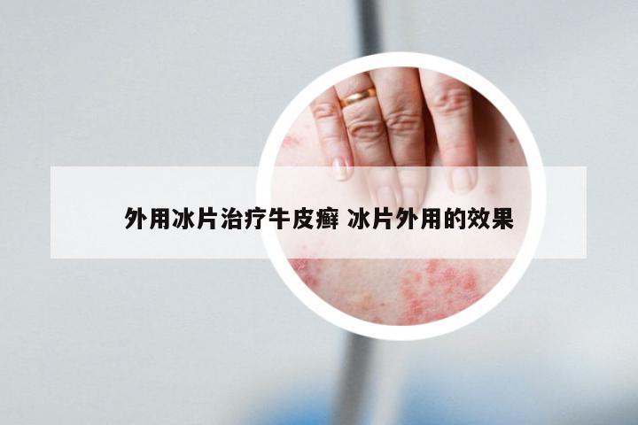 外用冰片治疗牛皮癣 冰片外用的效果