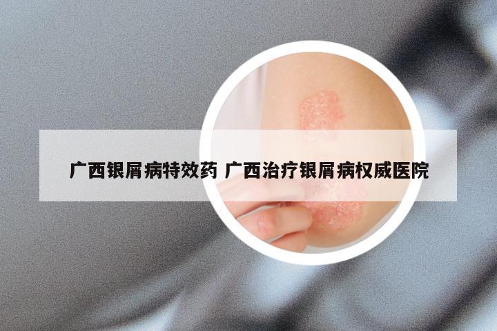 广西银屑病特效药 广西治疗银屑病权威医院