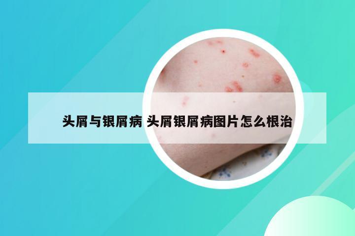 头屑与银屑病 头屑银屑病图片怎么根治