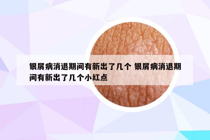 银屑病消退期间有新出了几个 银屑病消退期间有新出了几个小红点