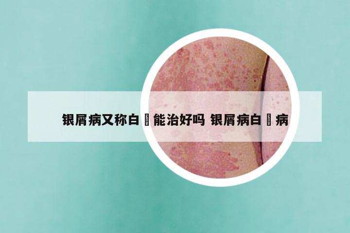 银屑病又称白疕能治好吗 银屑病白疕病