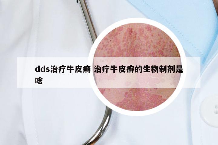 dds治疗牛皮癣 治疗牛皮癣的生物制剂是啥