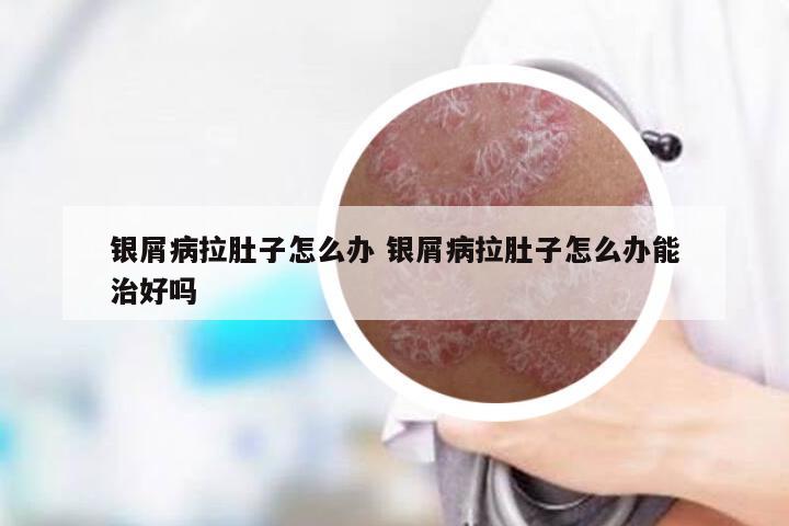 银屑病拉肚子怎么办 银屑病拉肚子怎么办能治好吗