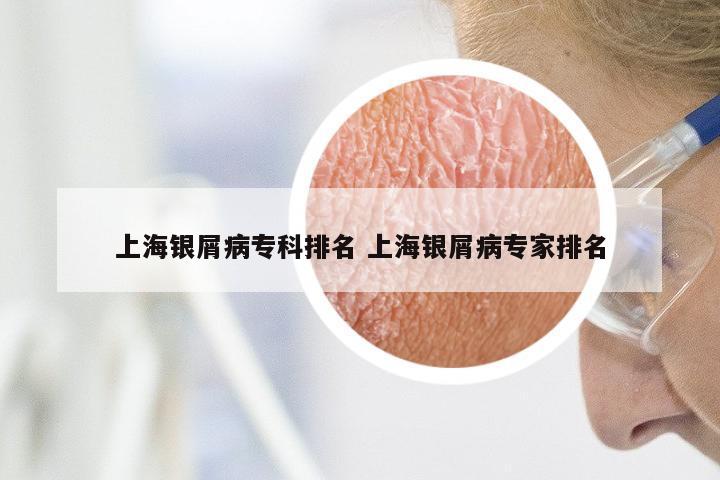 上海银屑病专科排名 上海银屑病专家排名