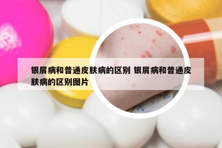 银屑病和普通皮肤病的区别 银屑病和普通皮肤病的区别图片