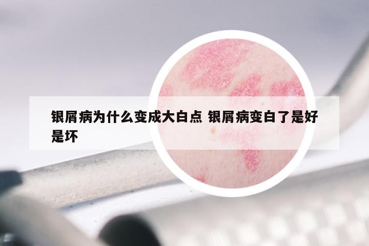 银屑病为什么变成大白点 银屑病变白了是好是坏
