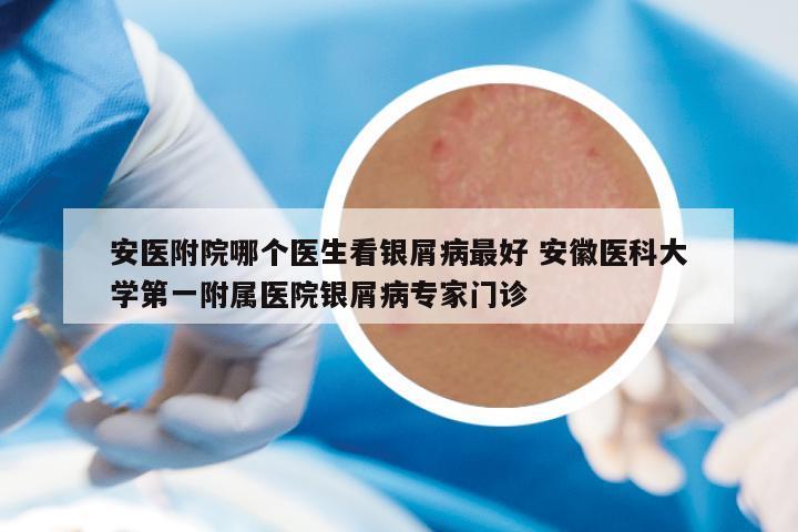 安医附院哪个医生看银屑病最好 安徽医科大学第一附属医院银屑病专家门诊