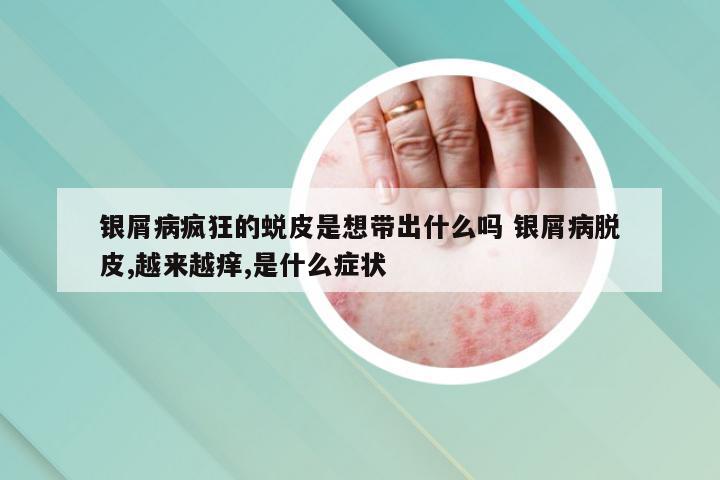 银屑病疯狂的蜕皮是想带出什么吗 银屑病脱皮,越来越痒,是什么症状