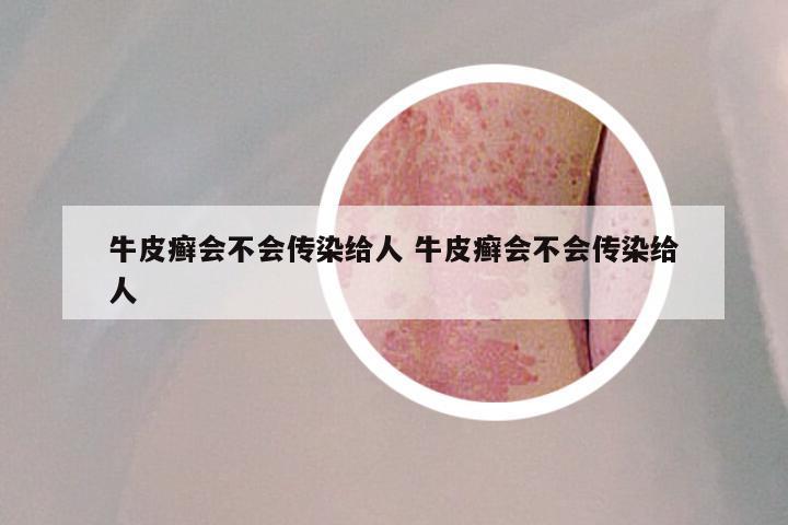 牛皮癣会不会传染给人 牛皮癣会不会传染给人