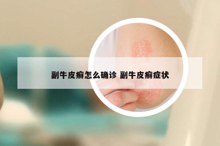 副牛皮癣怎么确诊 副牛皮癣症状