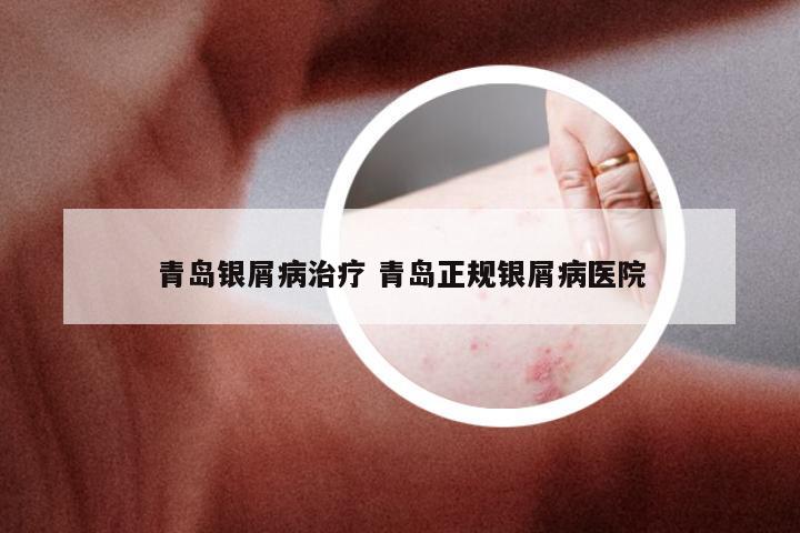 青岛银屑病治疗 青岛正规银屑病医院