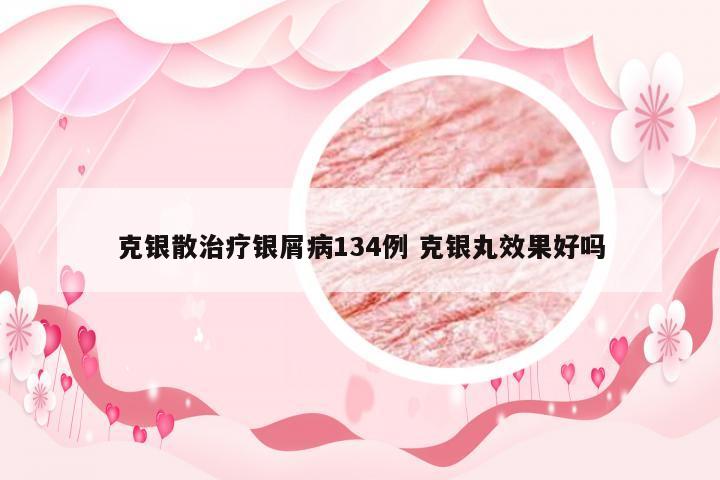 克银散治疗银屑病134例 克银丸效果好吗